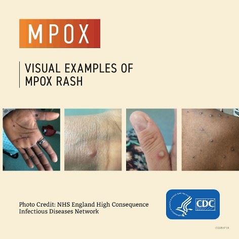 Mpox2